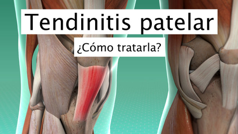 Miniatura para Tendinitis patelar
