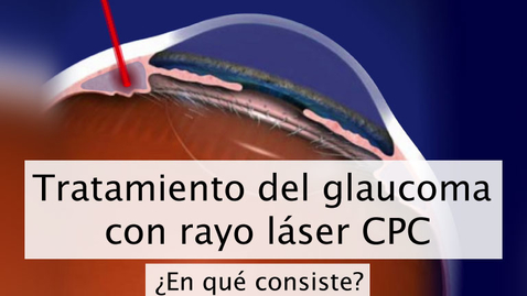 Miniatura para Tratamiento del glaucoma con rayo láser CPC