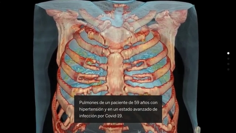 Miniatura para vídeo en 3D muestra por primera vez la infección que provoca el SARS-CoV-2 en los pulmones