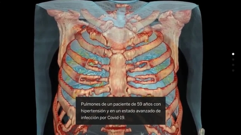 Miniatura para la entrada vídeo en 3D muestra por primera vez la infección que provoca el SARS-CoV-2 en los pulmones