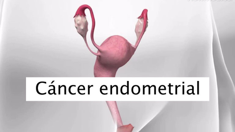 Miniatura para Cancer endometrial