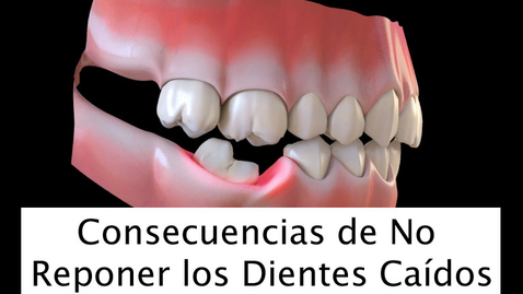 Miniatura para Consecuencias de No Reponer los Dientes Caídos