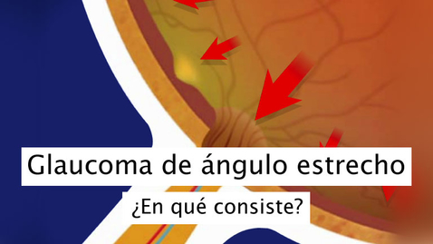 Miniatura para Acerca del glaucoma de ángulo estrecho