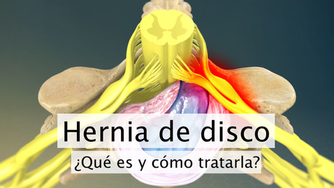 Miniatura para Hernia de disco