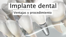 Ir a Implante dental con una duración de 1 minuto, 33 segundos