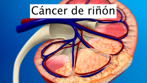 Miniatura para Cáncer de riñón