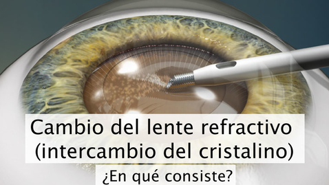 Miniatura para Cambio del lente refractivo ( intercambio del cristalino)