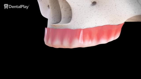 Miniatura para Maxilar Superior: Rehabilitación del Maxilar con 6 Implantes