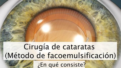 Miniatura para Cirugía de Cataratas facoemulsificacion