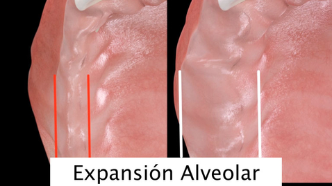Miniatura para Expansión Alveolar