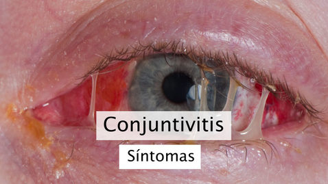 Miniatura para Conjuntivitis