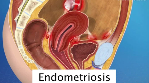 Miniatura para Endometriosis