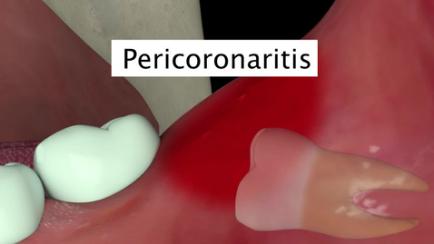 Miniatura para Pericoronaritis