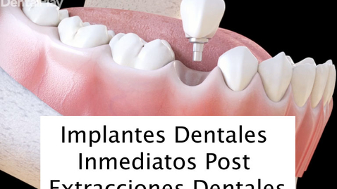 Miniatura para la entrada Implantes Dentales Inmediatos Post Extracciones Dentales