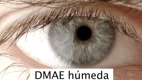 Miniatura para Degeneración macular asociada a la edad (DMAE húmeda)