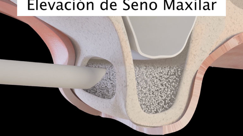 Miniatura para Elevación de Seno Maxilar