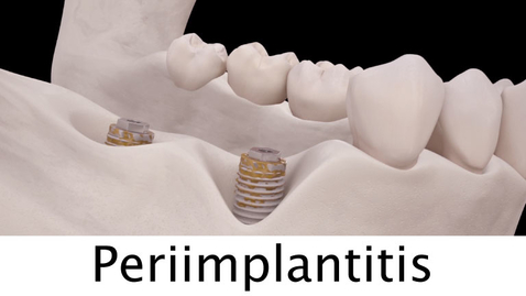 Miniatura para Periimplantitis