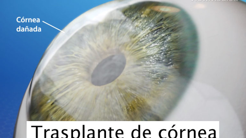 Miniatura para Trasplante de córnea 