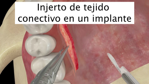 Miniatura para Injerto de tejido conectivo en un implante