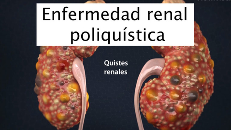Miniatura para Enfermedad renal poliquística