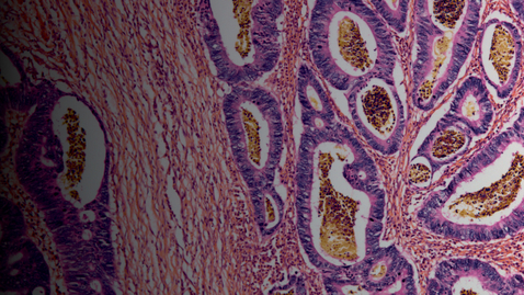 Thumbnail for First Annual Colorectal Cancer Updates for Primary Care - 02.19.22