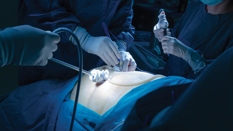 Thumbnail for 07- Fundoplication App: Calibration of the Fundoplication by Pat Reardon, MD.