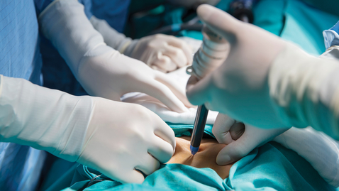 Thumbnail for 09- Fundoplication App: A Quick Review of Suture Placement by Patrick R. Reardon, MD