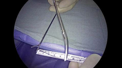 Thumbnail for 06- Fundoplication App: Creating a &quot;Suture Ruler&quot; by Patrick R. Reardon, MD
