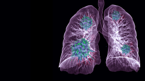 Thumbnail for Pulmonary Embolism 05.13.20