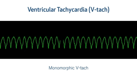 Thumbnail for ECG Interpretation: Lethal Arrhythmias