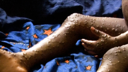 Mpox Outbreak in DRC