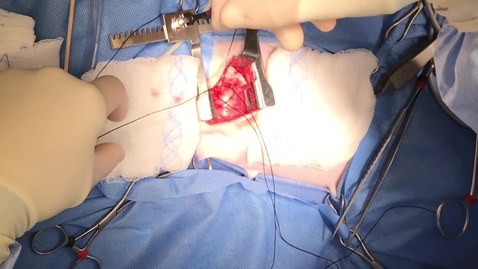 Thumbnail for Cardiovascular effects of surgical occlusion of a PDA