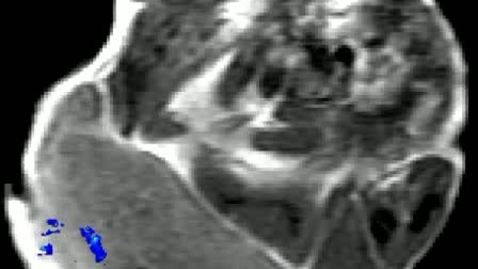 Thumbnail for Effect of Nanoshells on Mouse Tumor