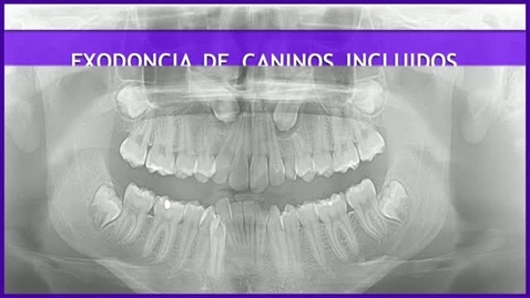 Miniatura para CIRUGÍA BUCAL II. EXODONCIA DE CANINOS INCLUIDOS