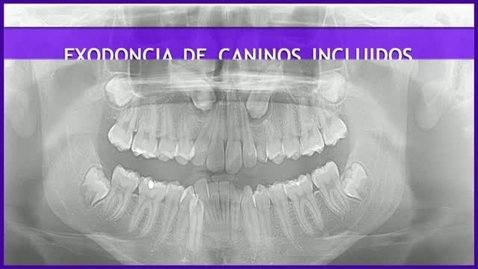 Miniatura para la entrada CIRUGÍA BUCAL II. EXODONCIA DE CANINOS INCLUIDOS