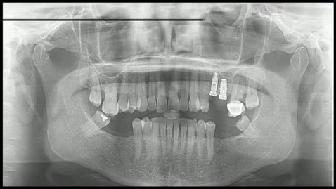 Miniatura para la entrada CIRUGÍA BUCAL II. CIRUGÍA IMPLANTOLÓGICA