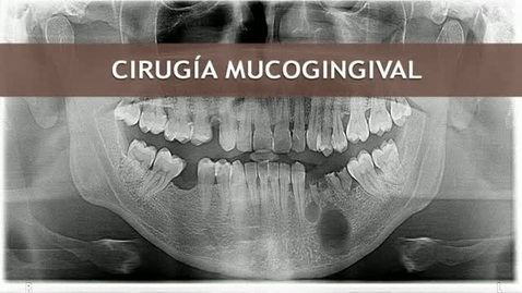 Miniatura para CIRUGÍA BUCAL II. CIRUGÍA MUCOGINGIVAL