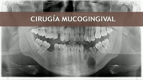 Miniatura para la entrada CIRUGÍA BUCAL II. CIRUGÍA MUCOGINGIVAL