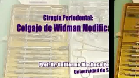 Miniatura para la entrada CIRUGÍA PERIODONTAL: COLGAJO DE WIDMAN MODIFICADO