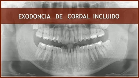 Miniatura para CIRUGÍA BUCAL II. EXODONCIA DE CORDAL INCLUIDO