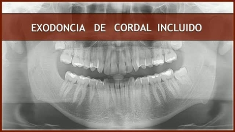 Miniatura para la entrada CIRUGÍA BUCAL II. EXODONCIA DE CORDAL INCLUIDO