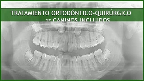 Miniatura para CIRUGÍA BUCAL II. TRATAMIENTO ORTODÓNTICO-QUIRÚRGICO DE CANINOS INCLUIDOS