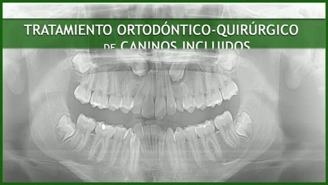 Miniatura para la entrada CIRUGÍA BUCAL II. TRATAMIENTO ORTODÓNTICO-QUIRÚRGICO DE CANINOS INCLUIDOS