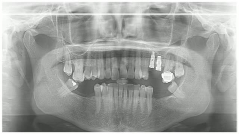 Miniatura para la entrada CIRUGÍA BUCAL II. SEGUNDA CIRUGÍA IMPLANTOLÓGICA