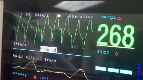 Thumbnail for Ventricular tachcardia clip.mov