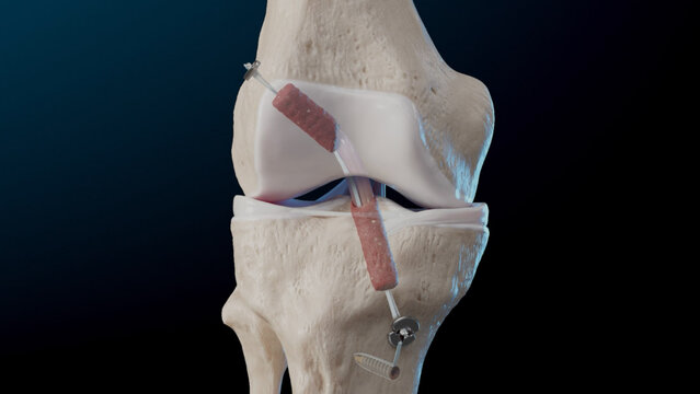 ACL Tears: ACL Reconstruction With Biologics, video thumbnail