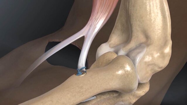 Distal Biceps Tendon Tears: Distal Biceps Repair With Metal Button Fixation, video thumbnail
