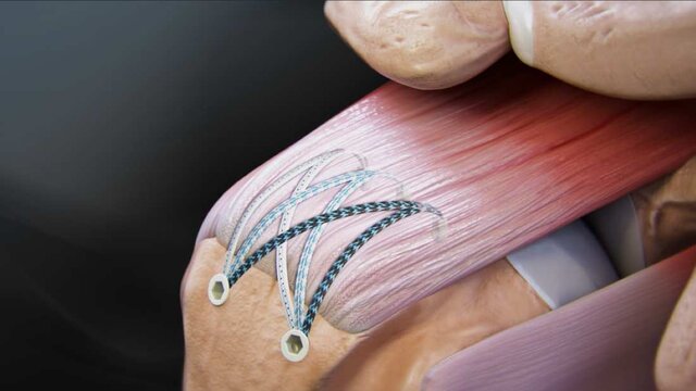 Rotator Cuff Tears: Double-Row Rotator Cuff Repair, video thumbnail