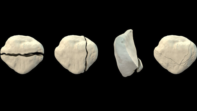 Kneecap (Patella) Fractures: Overview, video thumbnail