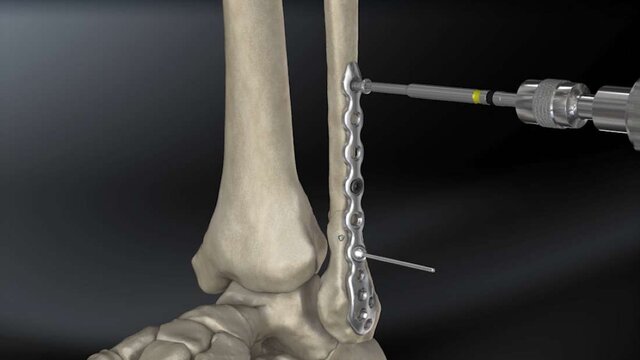 Ankle Fractures: Ankle Fracture Management, video thumbnail